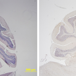 In the eye of the medulloblastoma