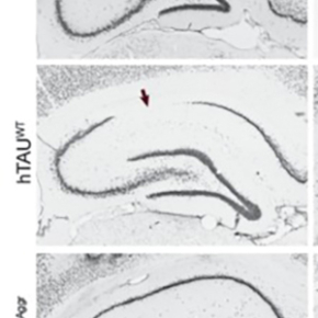 Maladie d’Alzheimer : un rôle protecteur des dégénérescences neurofibrillaires ?