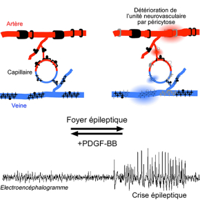 Péricytose dans le cerveau épileptique