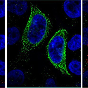 Cancer du sein : un duo de récepteurs envisagé comme piste thérapeutique